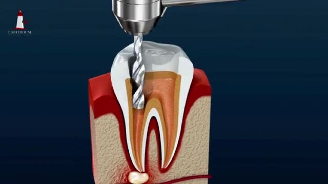 Why You Should Consider Root Canal Treatment at Lighthouse Dental Care