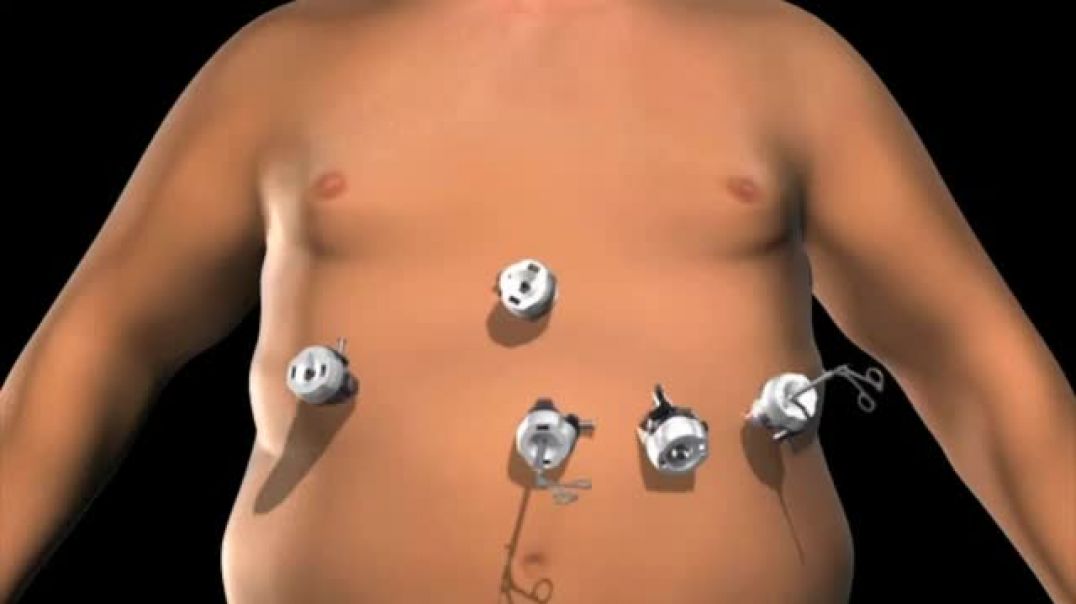 Laparoscopic Gastric Banding: Your Path to Effective Weight Management