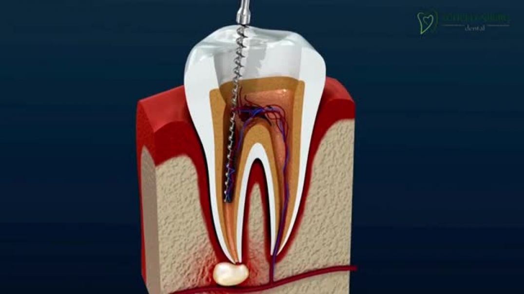 Tips to Prepare for Root Canal Therapy - Schellenberg Dental