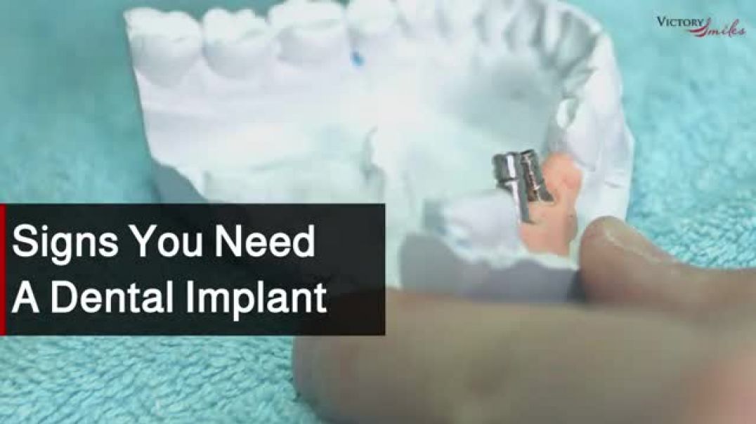 Key Indicators for Considering Dental Implants in The Woodlands